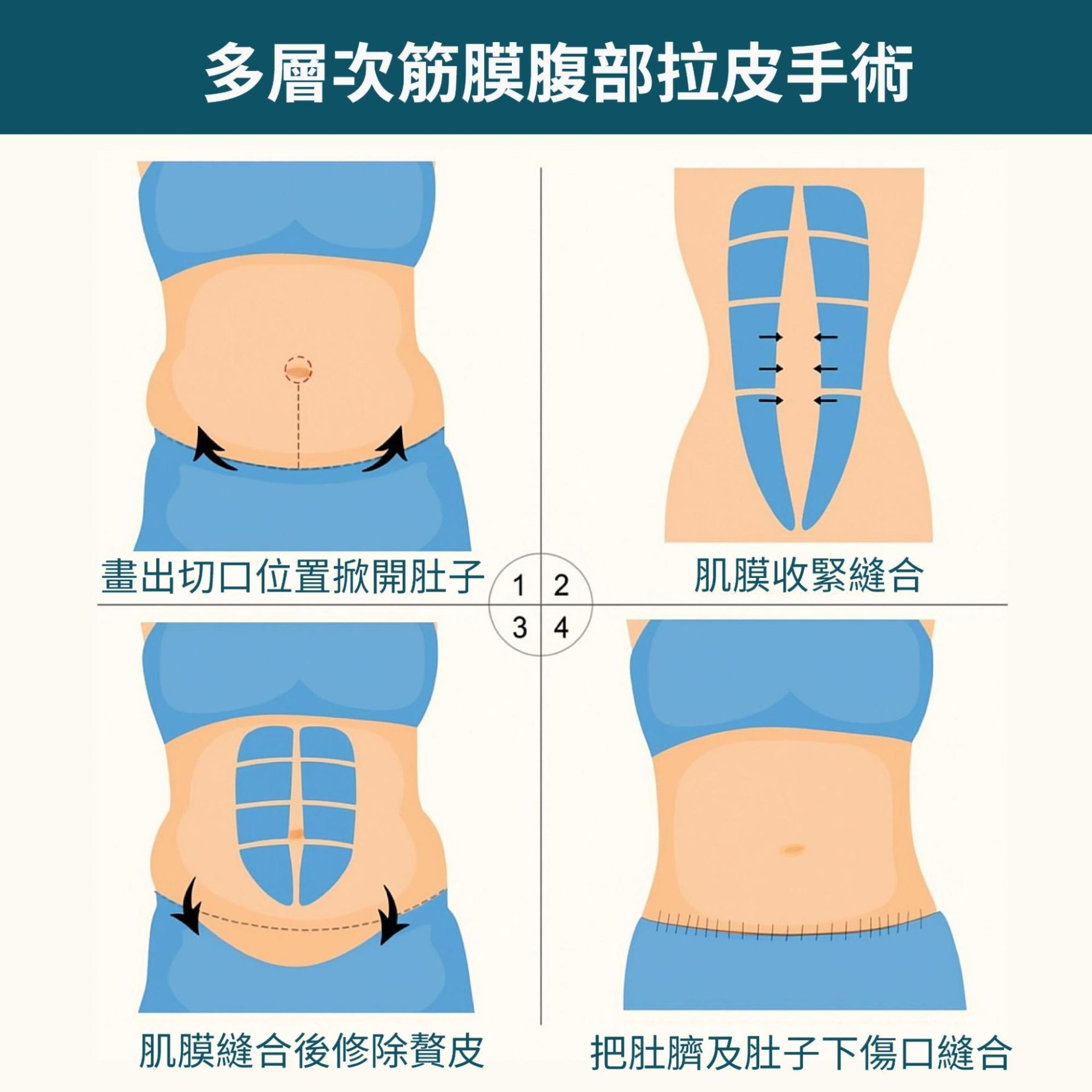 腹部拉皮手術原理
