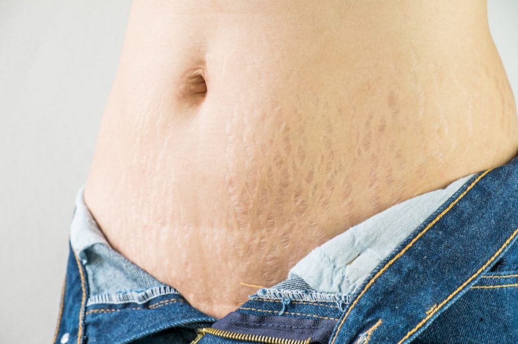 妊娠紋、肥胖紋