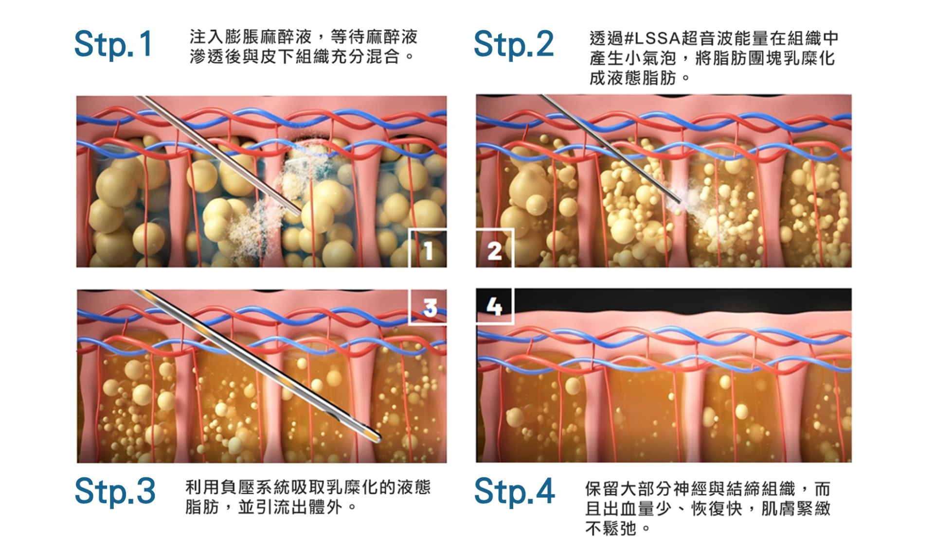 超音波溶脂原理示意一