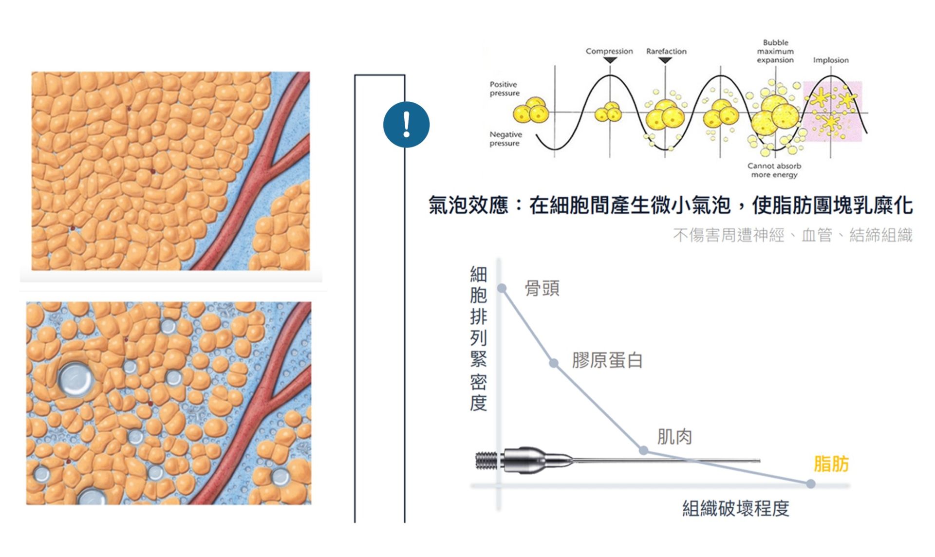 超音波溶脂原理示意二